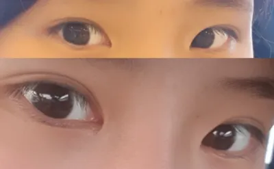 Өмнөд зовхи, давхар зовхины дахин мэс заслын 2 сарын дараах сэтгэгдэл~