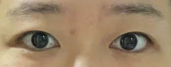 Зүсэлттэй хос зовхи, урд зүсэлт хийлгэсний дараах 5 сарын тойм