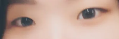 Будагтай зовхины өмнөх хагалгааны дараах сэтгэгдэл 🥰