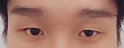 Давхар зовхигүй нүдний хэлбэр засах, урд зовхи нээлгэсний дараах 2 долоо хоног..