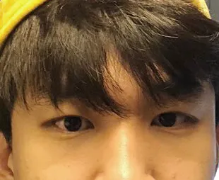 Эрэгтэй хүний нүдний хэлбэр засах мэс заслын 1 сарын дараах сэтгэгдэл!