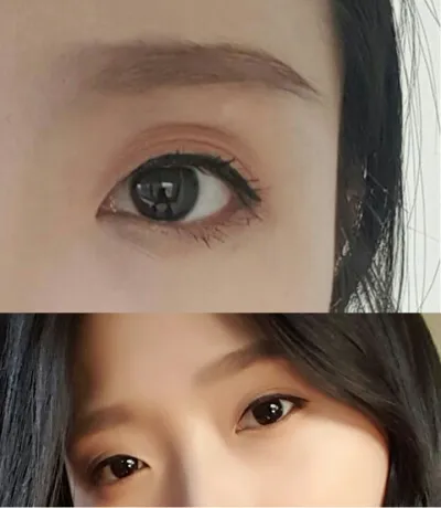 Зүсэлттэй нүдний хэлбэр засах + урд талын зүсэлт + дээд зовхины өөх шилжүүлэн суулгах мэс заслын дараах 6 сарын тойм