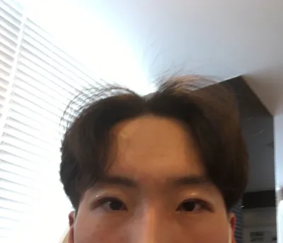 Эрэгтэй хүний нүдний хэлбэр засах мэс заслын дараах сэтгэгдэл.