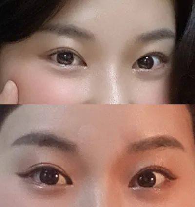 Хийсэн мэс ажилбараа дахин засуулсан, урд зүсэлт, хойд доод зүсэлт хийлгэсний дараах 1 жилийн тайлангаа бичлээ