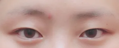 Нүдний хэлбэр засал хийлгэснээс хойш сар боллоо^^