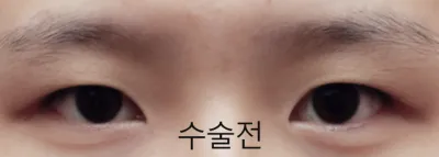 Зүсэлттэй нүдний хэлбэр засах + урд, хойд, доод зовхины мэс заслын үнэн сэтгэгдэл!!