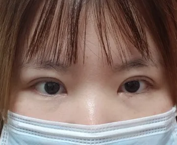 Давхар зовхины дахин хагалгаа, урд зовхины оёдлыг авхуулсан тухай сэтгэгдэл