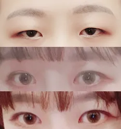 Нүдний хэлбэр засуулсан, урд зовхины мэс заслын дараах сэтгэгдэл