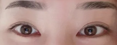 Зүсэлттэй нүдний хэлбэр засал, өмнөд зовхины тайралт хийлгээд хоёр сар боллоо