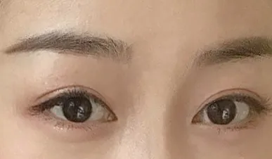 Зүсэлттэй зовхи өргөлт, урд зүсэлт хийлгэсний дараах 6 сарын сэтгэгдэл