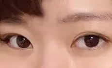 Булцуу+өмнөд зүсэлт хийлгэснээс хойш сар болж байнааа!!!!