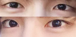 Эрэгтэй давхраагүй нүдний хэлбэр засал, урд зовхины мэс заслын дараах сэтгэгдэл