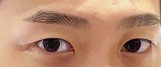 Давхар зовхигүй нүдний хэлбэр засал хийлгэснээс хойш сар боллоо