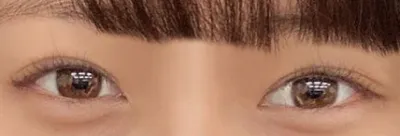 Эцэст нь нүдний мэс засал хийлгэлээ шүү~