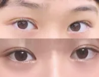 Давхрааны дахин хагалгаа