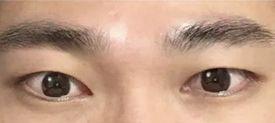 Эрэгтэй давхраагүй нүдний хэлбэр засах