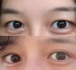 Хөмсөг өргөх мэс заслын дараах сэтгэгдэл