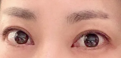 Давхар зовхины мэс засал