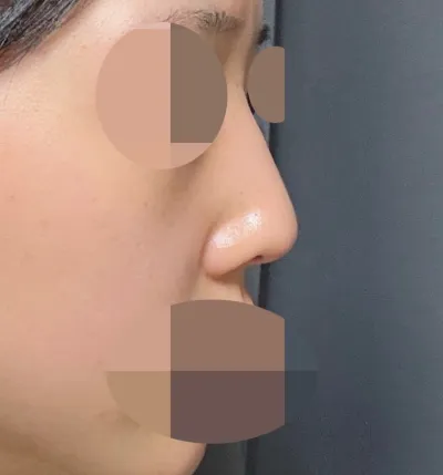 Хамрын таславч засах + доод хясаа авах мэс заслаар хамрын үйл ажиллагааг сайжруулах мэс засал хийлгэсэн!