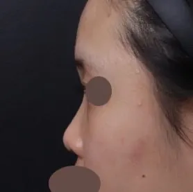 Бүгдээрээ Very Good гоо сайхны эмнэлэгт хамрын мэс засал хийлгээрэй!