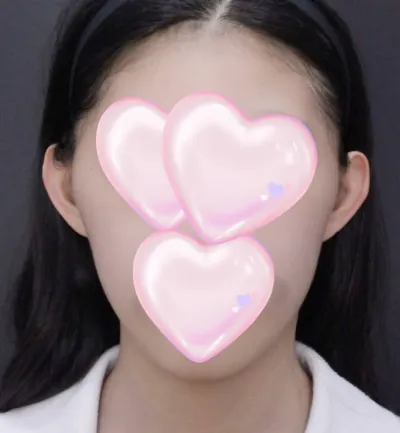 Өөрийн мөнгөөрөө шанаа, эрүүний үзүүр багасгах болон эрүү урагшлуулах мэс засал хийлгэсэн~