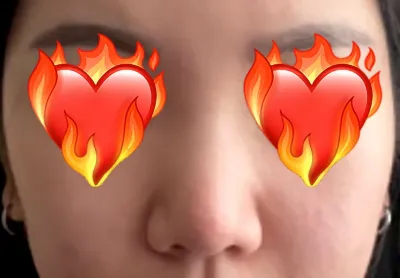 Өргөн хамрандаа санаа зовж байгаад Very Good-д хамрын хагалгаа хийлгэсэн