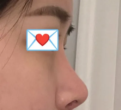 Very Good гоо сайхны эмнэлгийн Им Ён Мин захирлаар хамрын дахин хагалгаа хийлгэсэн!