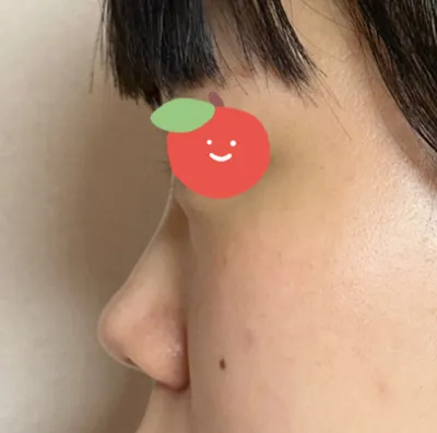 Хамрын үйл ажиллагааны хагалгаа хийлгэхээр 7 гаруй газраар явсан ч бүгд болохгүй гэсэн. Харин Very Good гоо сайхны эмнэлэгт гайморит хүртэл эмчлэх боломжтой гэж маш сайн тайлбарлаж өгсөн болохоор гэрээ хийсэн.