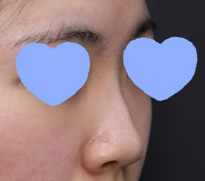 Анх зөвлөгөө авахаар очоод л шууд таалагдсан болохоор хагалгааны товоо товлоод, урьдчилгаа төлбөрөө ч өгөөд ирсэн..^^