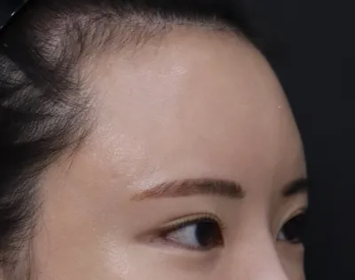 Хагалгааны өдөр бага зэрэг өвдөлттэй байсан ч үр дүн нь маш сайн байгаад баяртай байна! Нүд хөмсөг хоорондын зай холдож, духны хэмжээ багассан~^^