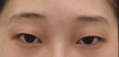 Давхрааны хагалгаа хийлгэх эсэхдээ эргэлзэж байгаа хүмүүс олон газар явалгүй Вери Гүүд гоо сайхны мэс заслын эмнэлэгт ирж зөвлөгөө аваарай(ⓐⓐ) °◇°