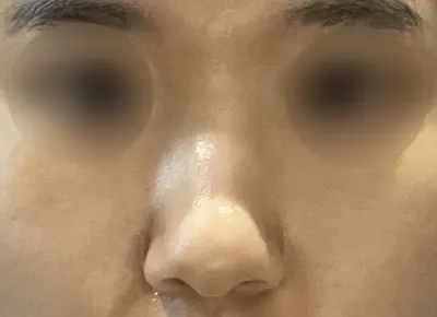 Хагалгаа хийлгээд 2 сар болж байна, маш их сэтгэл хангалуун байгаа бөгөөд ямар ч гаж нөлөөгүй сайн байгаа.