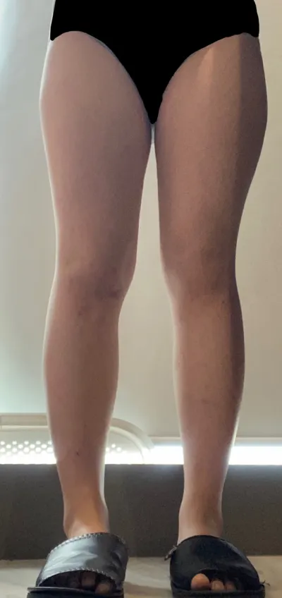 Маш олон төрлийн дэглэм барьж үзсэн ч гуяны өөх огт хасагдахгүй байсан болохоор их стресстдэг байсан. Өөх соруулах нь л зөв шийдэл юм байна..