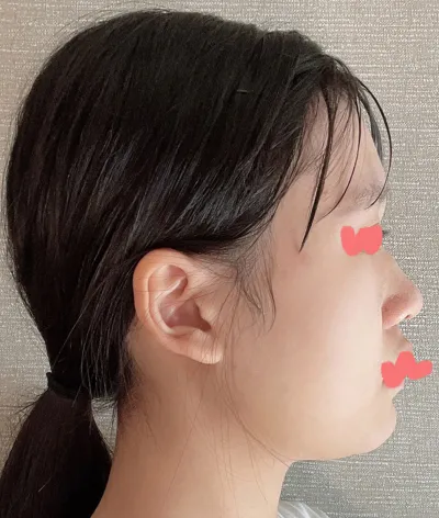 Маш их сэтгэл хангалуун байна, өөртөө итгэх итгэл ч нэмэгдсэн. Хамрын хагалгаа хийлгэх эсэхдээ эргэлзэж байгаа бол зүгээр л хийлгэсэн нь дээр гэж бодож байна.