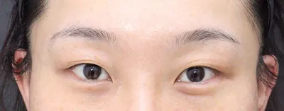 Хэрвээ өөр газар дахин хийлгэхээр болбол Very Good гоо сайхны эмнэлэгт хамгийн түрүүнд ирэх байх. Хүчтэй санал болгож байна!!