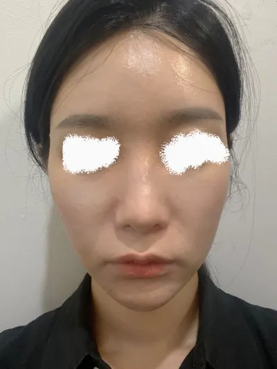 Өнгөрсөн жил захирлаар эрүүний хагалгаа (урт муруй) хийлгээд сэтгэл хангалуун байсан болохоор