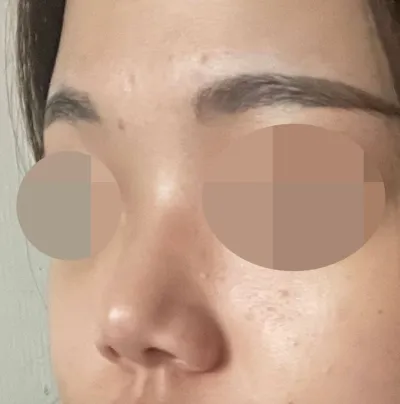 Богино хамар, намхан хамрын нуруундаа их санаа зовдог байсан болохоор хагалгаа хийлгэхээр шийдсэн!