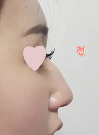 Эргэн тойрныхон маань ч хамар гоё болсон байна гэж бүгд магтсан.