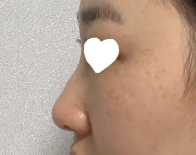 Хамрын салстын хагалгаа хийлгэх дашрамдаа хамрын нурууны товгорыг засаж, хамрын гоо сайхны хагалгааг хамт хийлгэсэн.