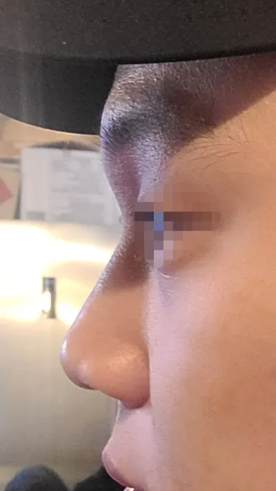 Эрэгтэй хүний хамрын хагалгааг үнэхээр сайн хийдэг юм байна. Very Good гоо сайхны эмнэлгийг санал болгож байна.