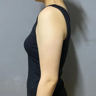 Гарны өөх соруулах хагалгааны хагас жилийн дараах сэтгэгдэл!