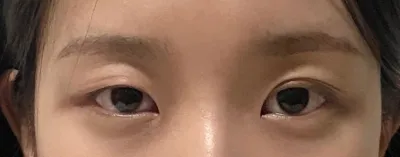 Давхрааны наалт наах шаардлагагүй болсон чинь амьдралын чанар өөрчлөгдлөө.. Маш их сэтгэл хангалуун байна >_<