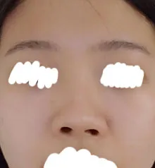 Анхны хамрын хагалгаа буруу болсноос болоод хамар муруй, намхан, хамрын нүхнүүд тэгш бус гээд нийтдээ асуудалтай байсан ч