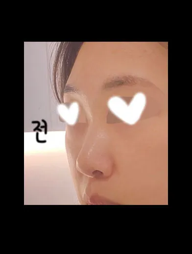 Хамрын үйл ажиллагаа засах хагалгаа хийлгээд 4 сар болж байна ㅎㅎ