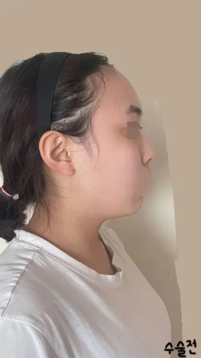 Хагалгаа хийлгээд 3 сар болсны дараах сэтгэгдэл!