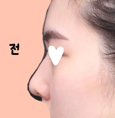 Very Good гоо сайхны эмнэлэгт хамрын хагалгаа (анхны хамар) хийлгээд аль хэдийн 2 долоо хоног болчихлоо!