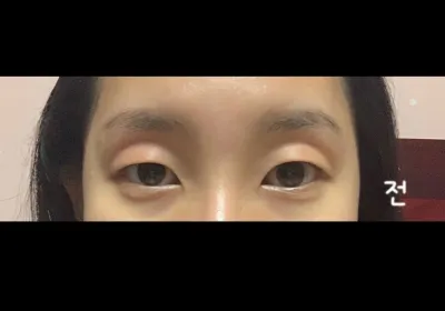 Бүгд заавал нүдний дотор булан нээлгэх (epicanthoplasty) хагалгаа хийлгээрэй ㅜㅜ