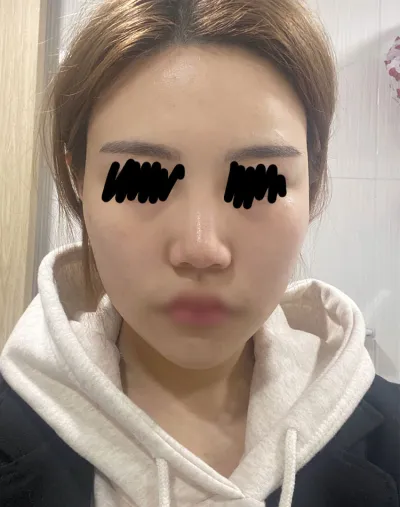 Нүүрний хэлбэр засах хагалгааны 3 сарын дараах сэтгэгдэл