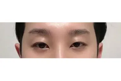 Хагалгааны 6 сарын дараах сэтгэгдэл.