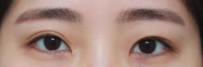 Нүдний хагалгаа (дахин хагалгаа) 3 сарын дараах сэтгэгдэл,,,